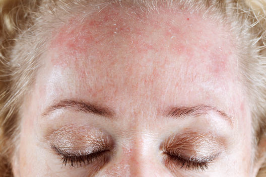 Zits remedy reviews las vegas dermatologist acne