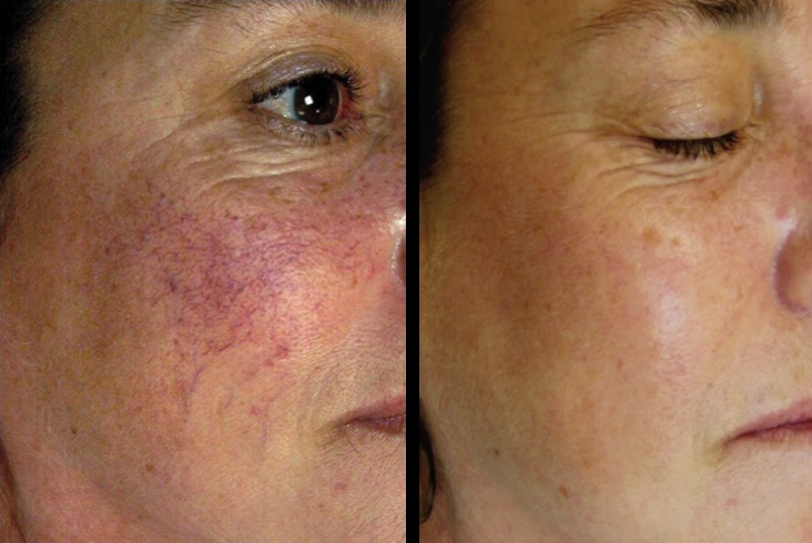 Broken Capillaries Treatment –– by Advanced Dermatology