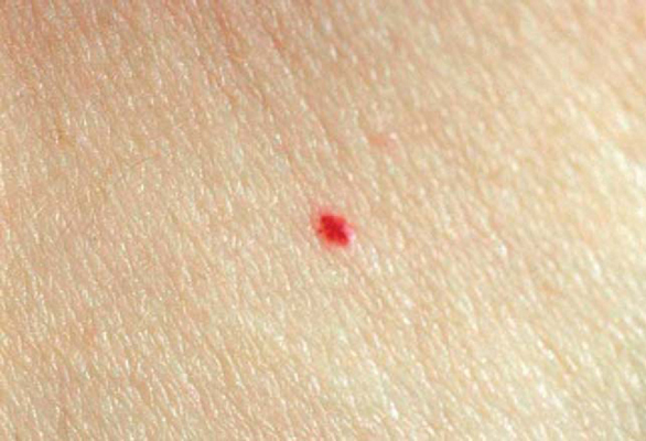 Cherry Angioma — Advanced Dermatology