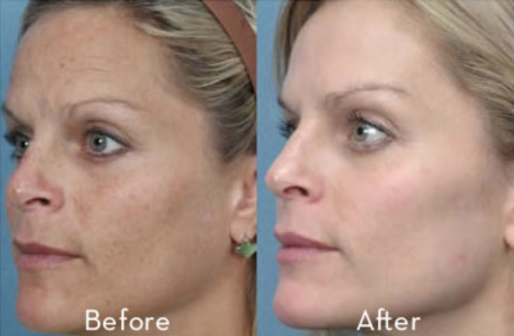 laser treatment for wrinkles reviews