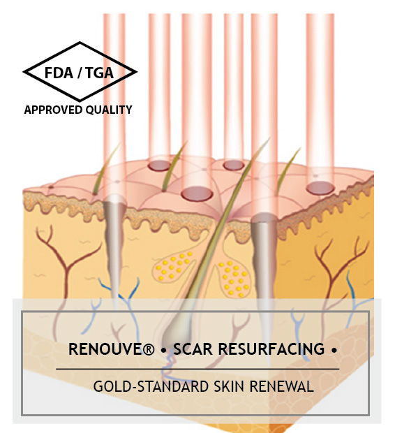 scar-resurfacing scar-resurfacing