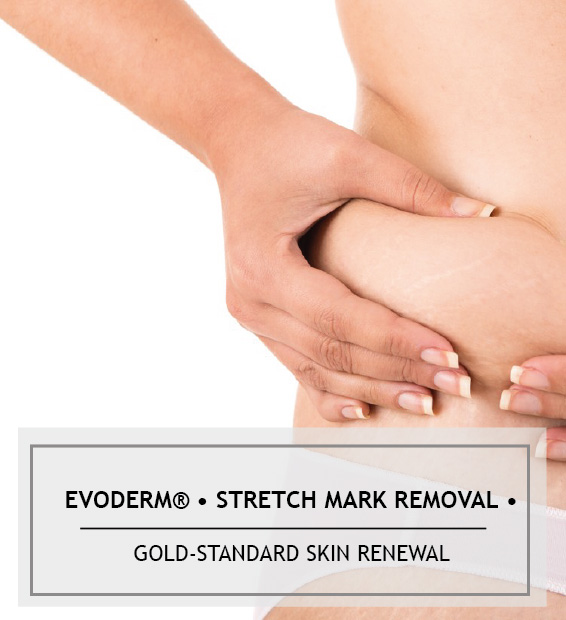 evoderm-stretchmarkremoval evoderm-stretchmarkremoval