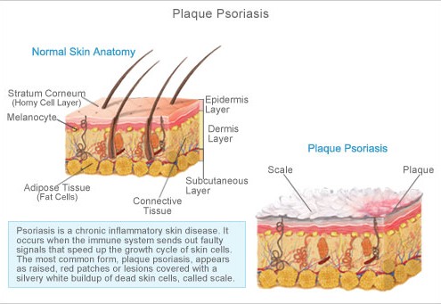 Psoriasis