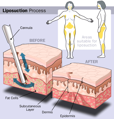 liposuction