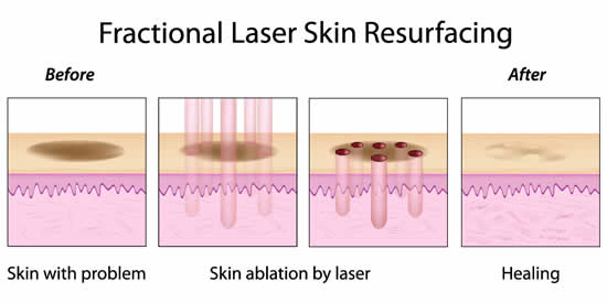 emerge-fractional-laser