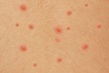 Chickenpox - Wikipedia