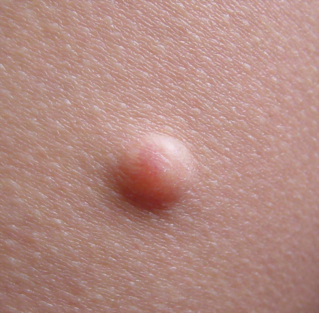 Basal Cell Carcinoma Pictures - Images of Skin Cancer