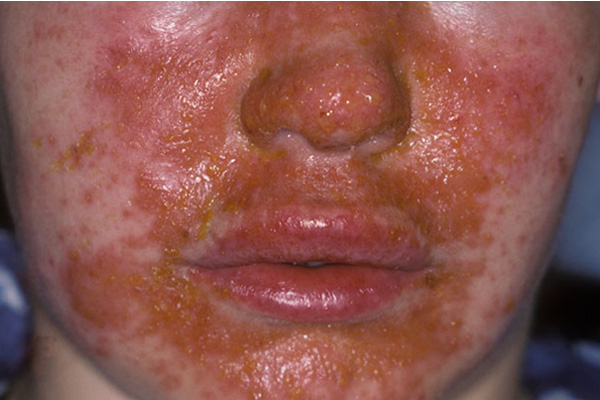 Cellulitis — Advanced Dermatology