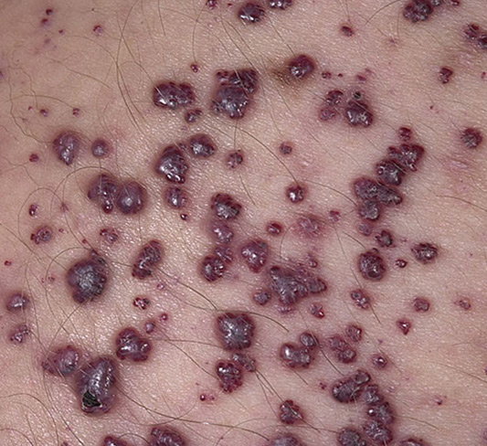 fabry disease advanced dermatology fabry disease advanced dermatology