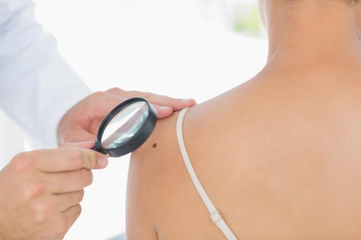 All you should know about Liver Spots All you should know about Liver Spots