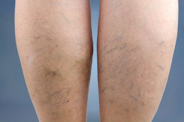 thread-veins thread-veins