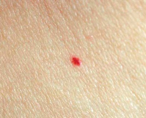 cherry angioma