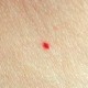 cherry angioma