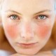 Advanced Dermatology - Rosacea