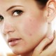 Advanced Dermatology - Adult Acne Treatment