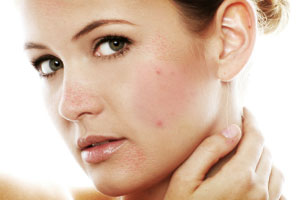 Advanced Dermatology - Adult Acne Treatment