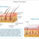 Psoriasis