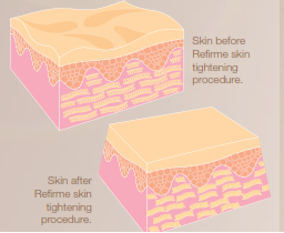 Refirme_Skin-Tightening-Image