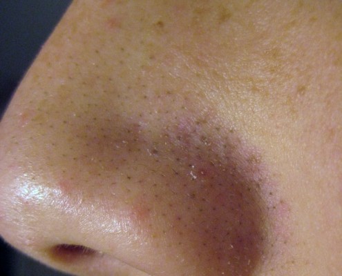 Blackheads