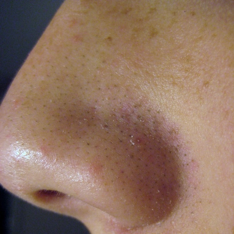 Blackheads and Large Pores — Advanced Dermatology
