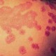 Erythema