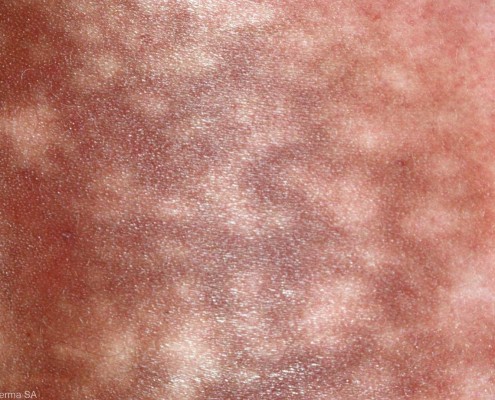 Erythema-Ab-Igne