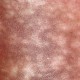 Erythema-Ab-Igne