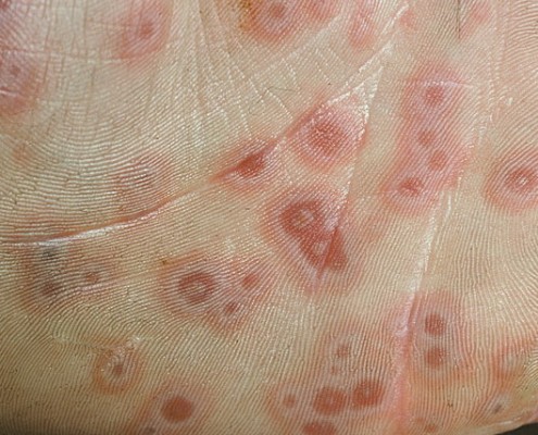 Erythema-Multiforme