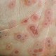 Erythema-Multiforme