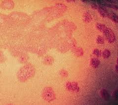 Erythema