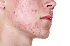 acne-treatment