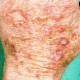 actinic_keratosis