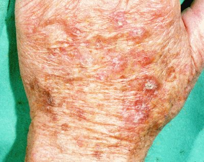 actinic_keratosis