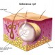 advanced-derma-cyst