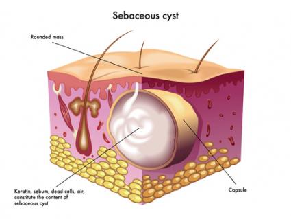 advanced-derma-cyst