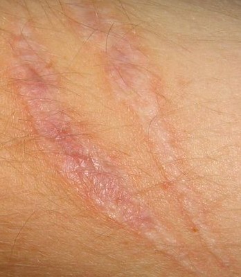 scar atrophic