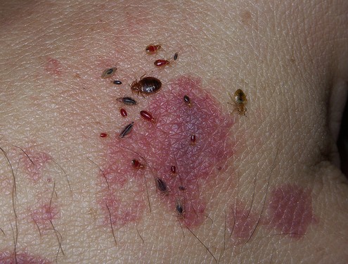 body-lice-symptoms-prevention-treatment