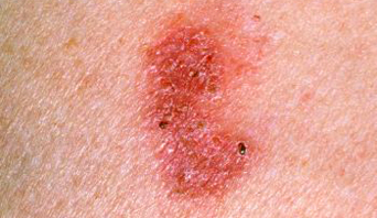 bowens-disease