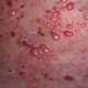 bullous-pemphigoid