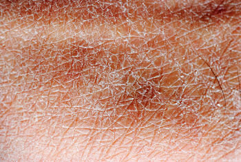 dry-skin