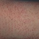 keratosis pilaris