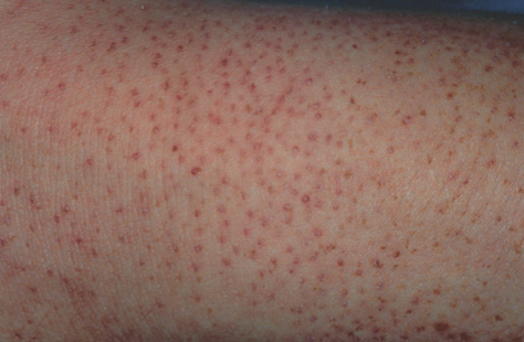 keratosis pilaris