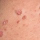 skin tags