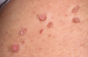 skin tags