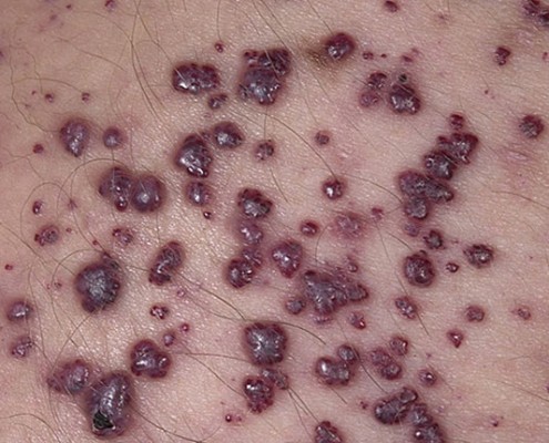 Fabry-Disease