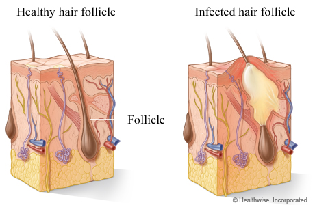 Folliculitis