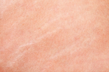 Stretch marks