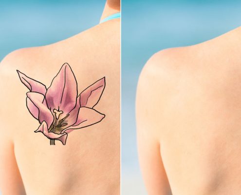 Tattoo-Removal-Sydney