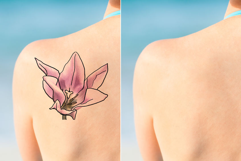 Tattoo Removal Sydney — Advanced Dermatology Tattoo Removal Sydney — Advanced Dermatology