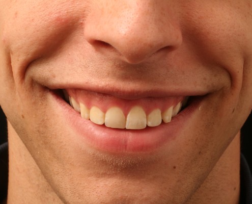 Botox-Gummy-Smile-Before